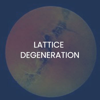 Lattice Degeneration Treatment Near Me in New Haven CT, Hamden CT, Madison CT, Trumbull CT, Norwalk CT, and Fairfield, CT Lattice Degeneration Treatment Near Me in New Haven CT, Hamden CT, Madison CT, Trumbull CT, Norwalk CT, and Fairfield, CT
