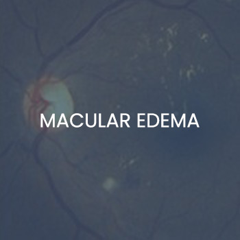 Macular Edema Treatment Specialist Near Me in New Haven CT, Hamden CT, Madison CT, Trumbull CT, Norwalk CT, and Fairfield, CT Macular Edema Treatment Specialist Near Me in New Haven CT, Hamden CT, Madison CT, Trumbull CT, Norwalk CT, and Fairfield, CT