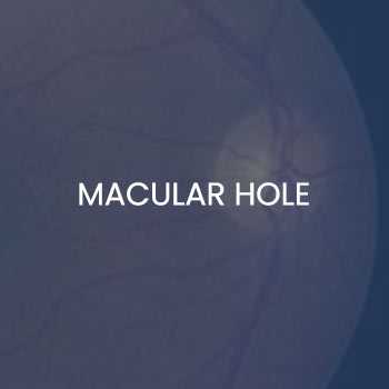 Macular Hole Treatment Near Me in New Haven CT, Hamden CT, Madison CT, Trumbull CT, Norwalk CT, and Fairfield, CT Macular Hole Treatment Near Me in New Haven CT, Hamden CT, Madison CT, Trumbull CT, Norwalk CT, and Fairfield, CT