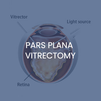 Pars Plana Vitrectomy Specialist Near Me in New Haven CT, Hamden CT, Madison CT, Trumbull CT, Norwalk CT, and Fairfield, CT Pars Plana Vitrectomy Specialist Near Me in New Haven CT, Hamden CT, Madison CT, Trumbull CT, Norwalk CT, and Fairfield, CT